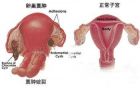 卵巢囊肿与正常子宫的区别